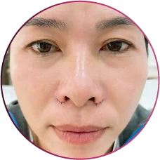 phẫu thuật thu gọn cánh mũi