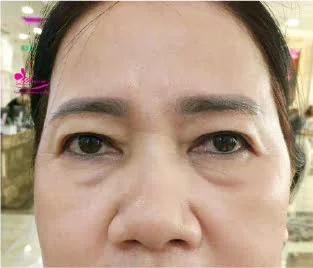 làm đầy thái dương