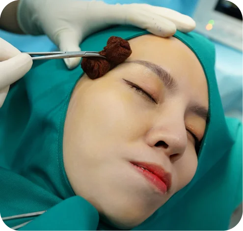 làm đầy thái dương