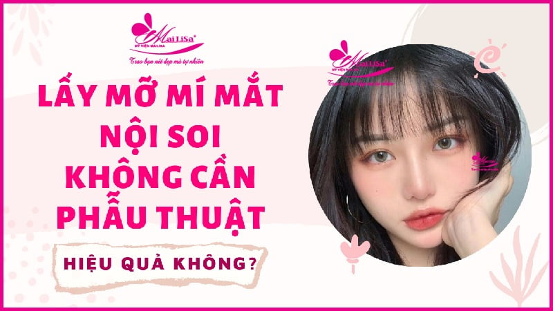 lấy mỡ mí mắt nội soi