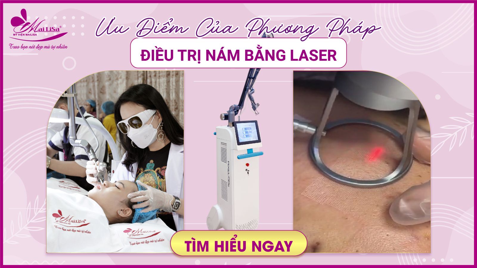 ưu điểm của phương pháp điều trị nám bằng laser 