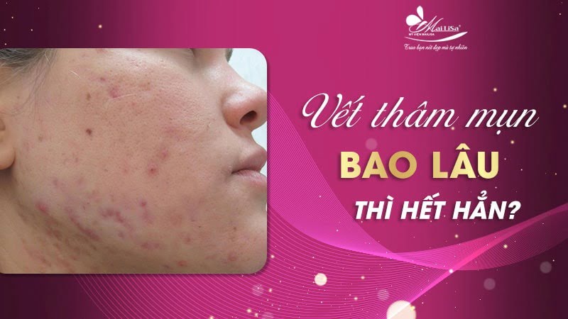 thâm mụn có tự hết không