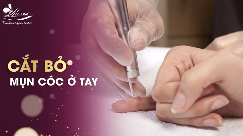 cách trị mụn cóc ở tay