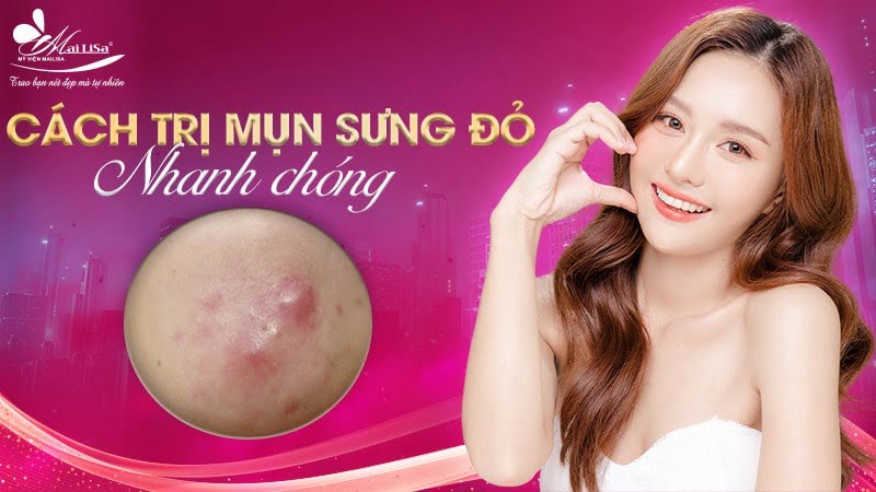 cách trị mụn sưng đỏ