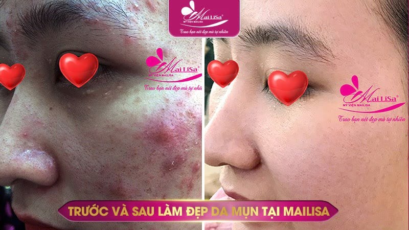 cách trị mụn sưng đỏ