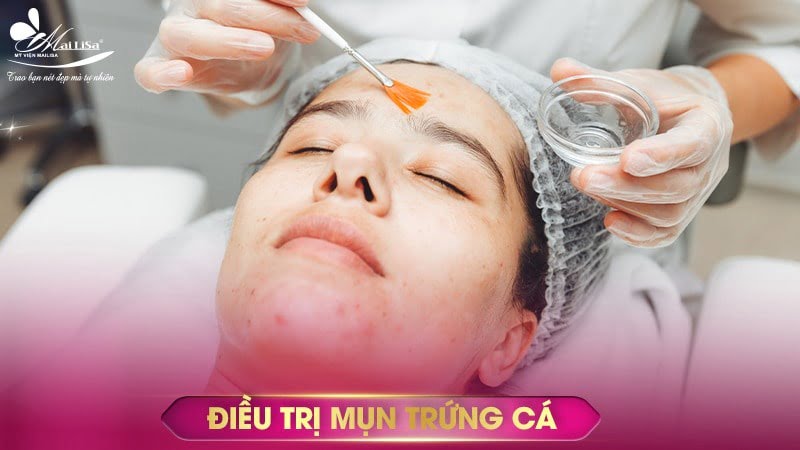 có nên nặn mụn không