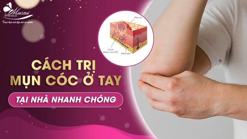 Cách trị mụn cóc ở tay