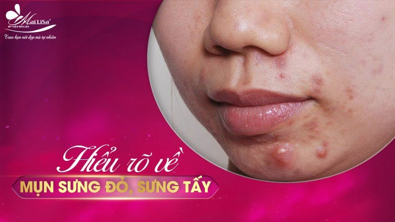 cách trị mụn sưng đỏ