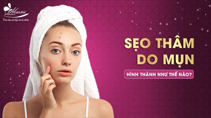 trị sẹo và thâm mụn