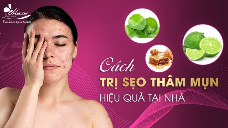 trị sẹo và thâm mụn