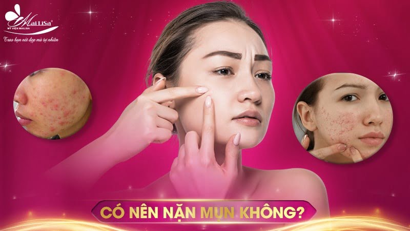 có nên nặn mụn không