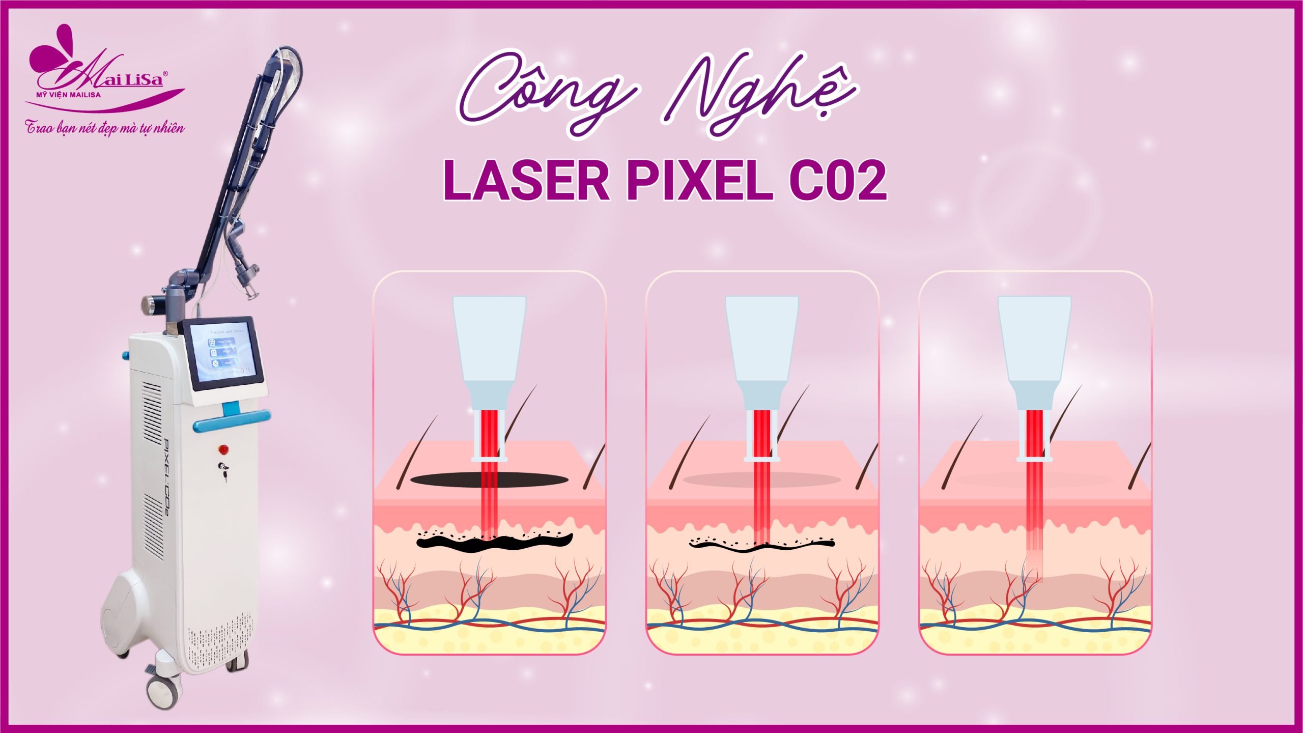 cong-nghe-laser-pixel-co2