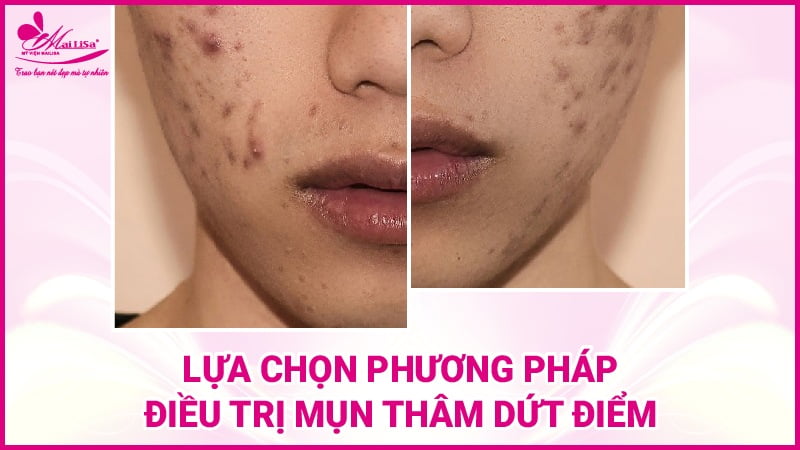 lua-chon-phuong-phap-tri-tham-mun