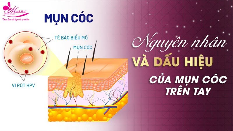 cách trị mụn cóc ở tay