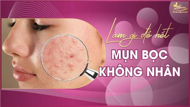 Cách làm xẹp mụn bọc không nhân nhanh chóng và an toàn