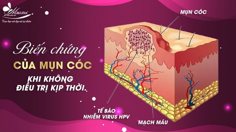 cách trị mụn cóc ở tay