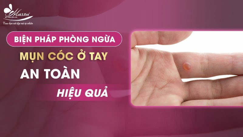 cách trị mụn cóc ở tay