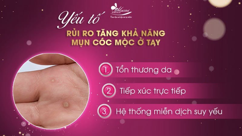 cách trị mụn cóc ở tay