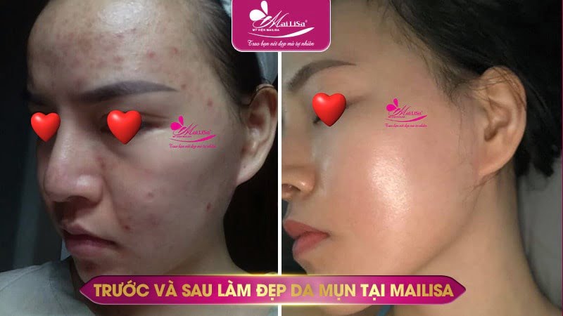 cách trị mụn sưng đỏ