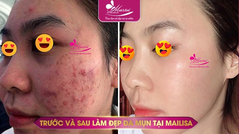 cách trị mụn sưng đỏ