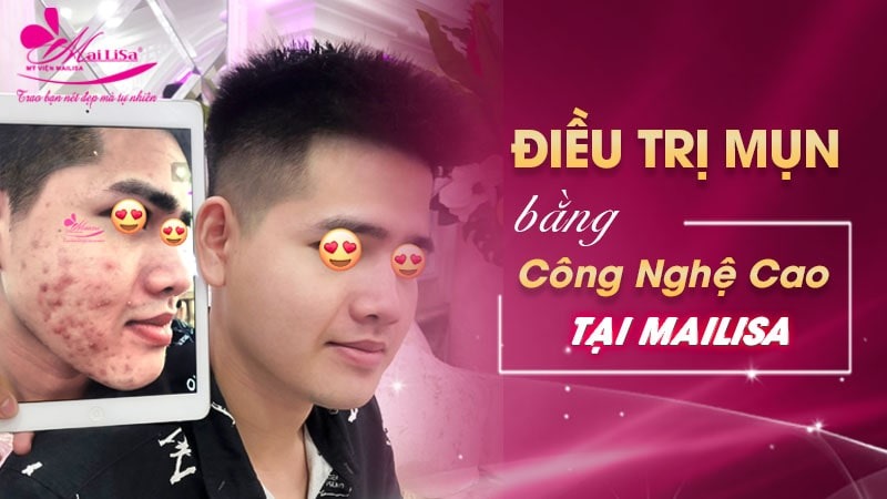 trị mụn cám ở mũi