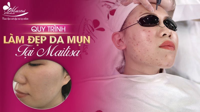 cách trị mụn sưng đỏ