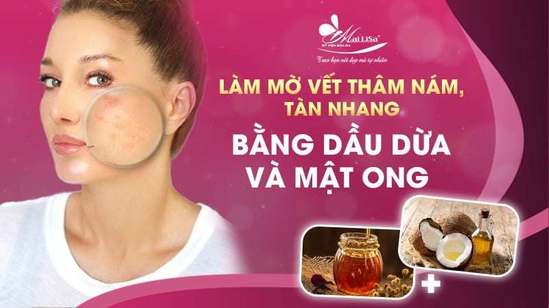 tàn nhang bẩm sinh có chữa được không