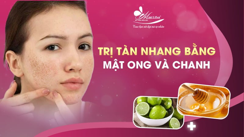 tàn nhang bẩm sinh có chữa được không