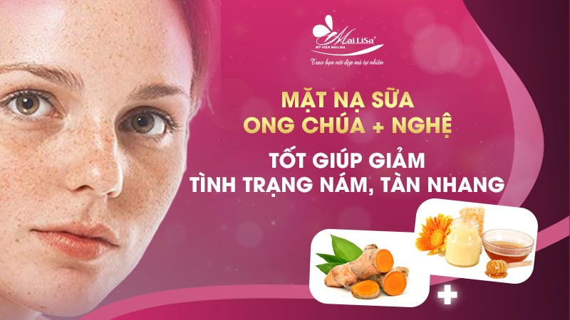 tàn nhang bẩm sinh có chữa được không