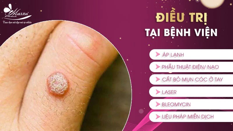 cách trị mụn cóc ở tay