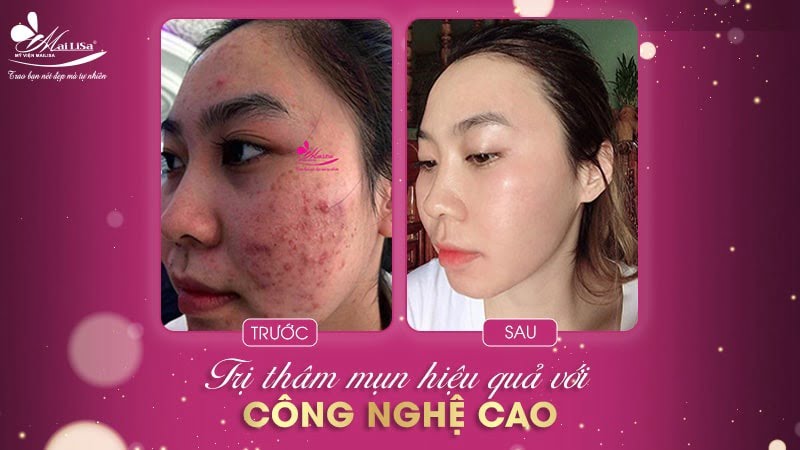 thâm mụn có tự hết không