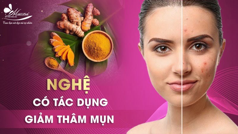 thâm mụn có tự hết không