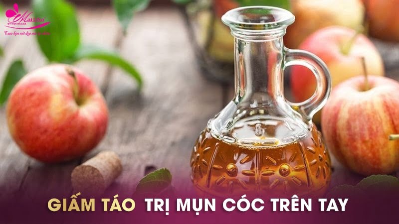 cách trị mụn cóc ở tay