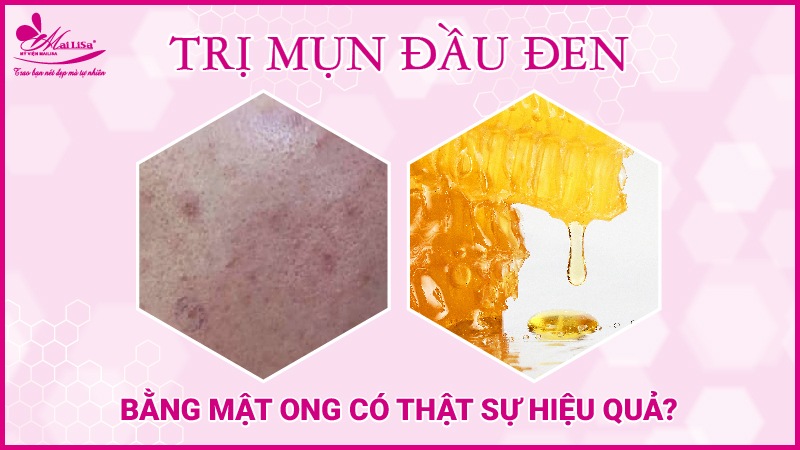 tri-mun-bang-mat-ong-co-that-su-hieu-qua