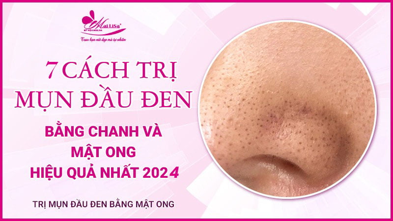 trị mụn đầu đen bằng mật ong