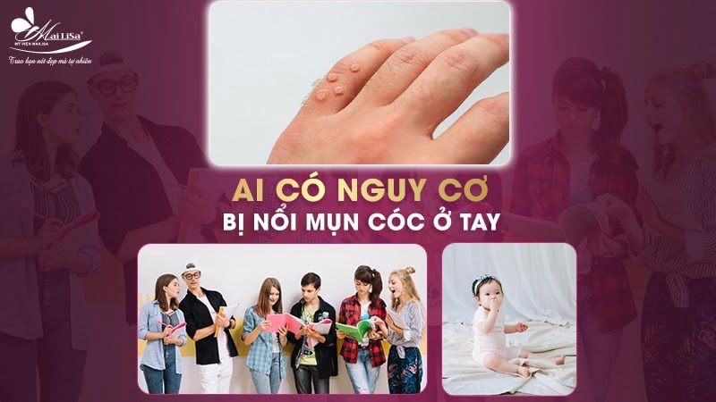 cách trị mụn cóc ở tay