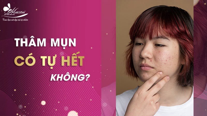 thâm mụn có tự hết không