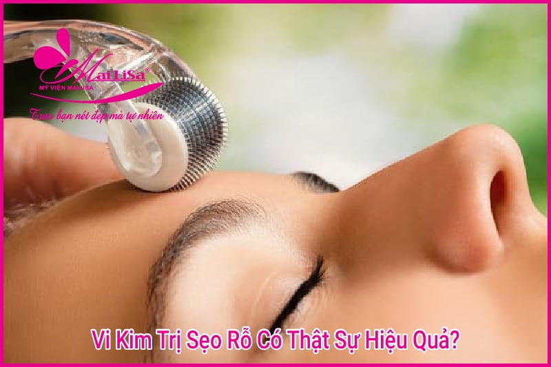 vi kim trị sẹo rỗ