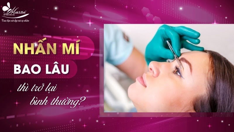 nhấn mí bao lâu trở lại bình thường