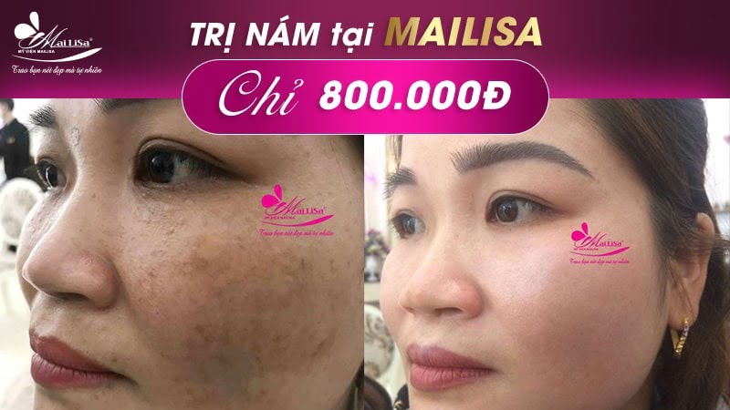 bắn laser trị nám bao nhiêu tiền