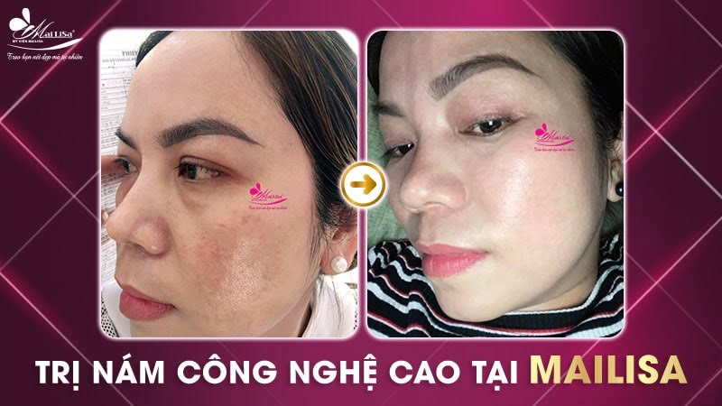 bắn laser trị nám bao nhiêu tiền