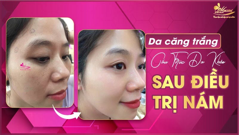 cách trị nám tàn nhang