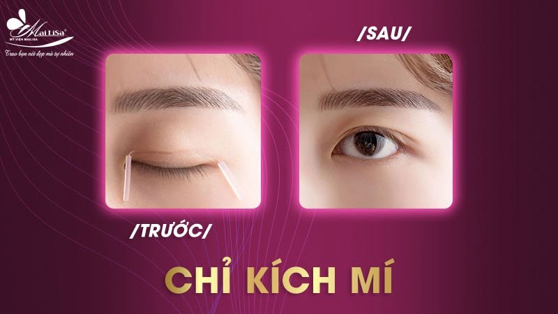 cách kích mí vĩnh viễn