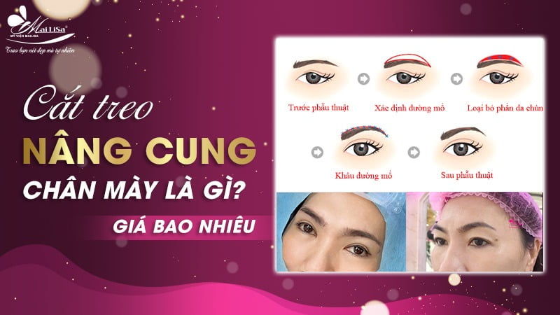 cắt treo nâng cung chân mày