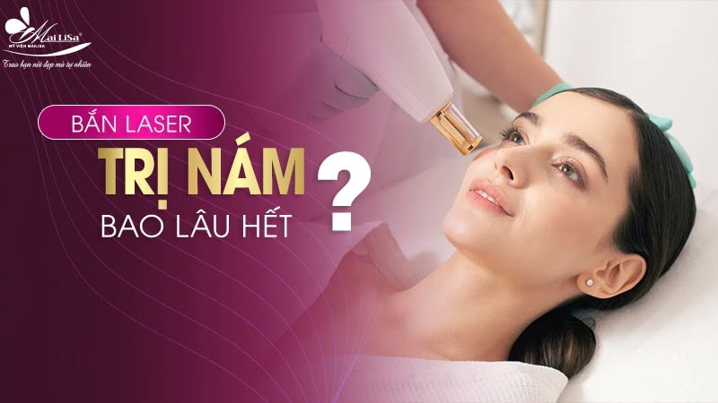 bắn laser trị nám bao nhiêu tiền