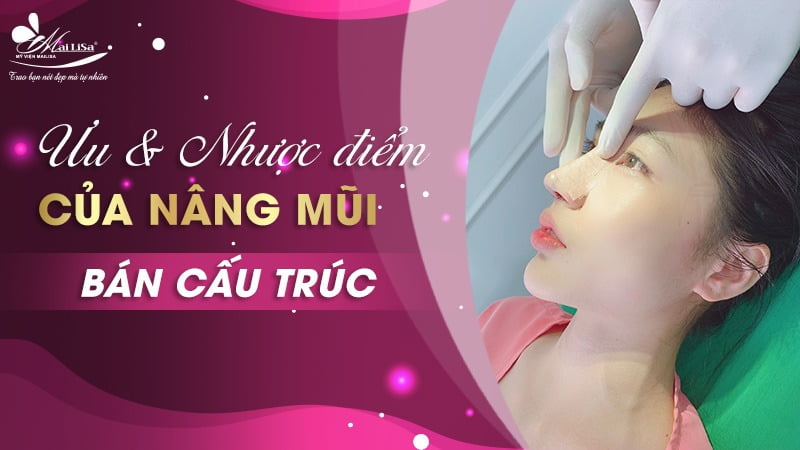 nâng mũi bán cấu trúc