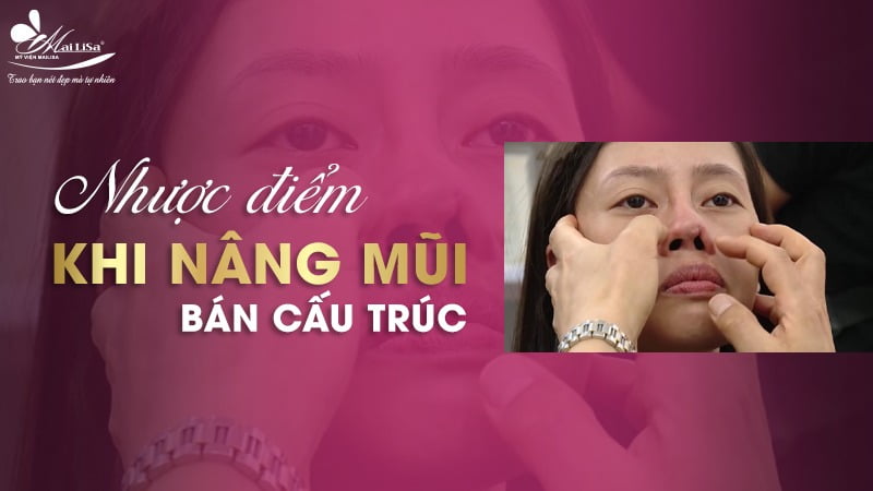 nâng mũi bán cấu trúc