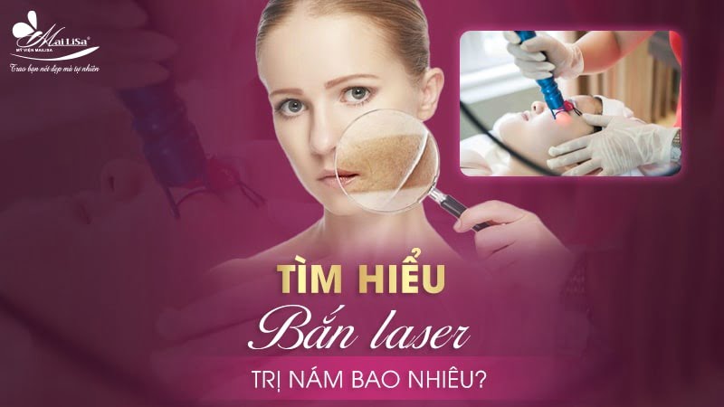 bắn laser trị nám bao nhiêu tiền