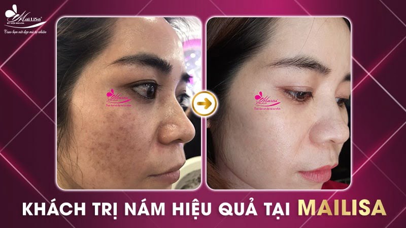 bắn laser trị nám bao nhiêu tiền