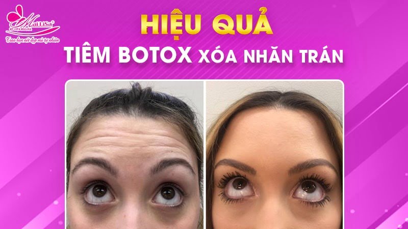 ai-khong-nen-tiem-botox